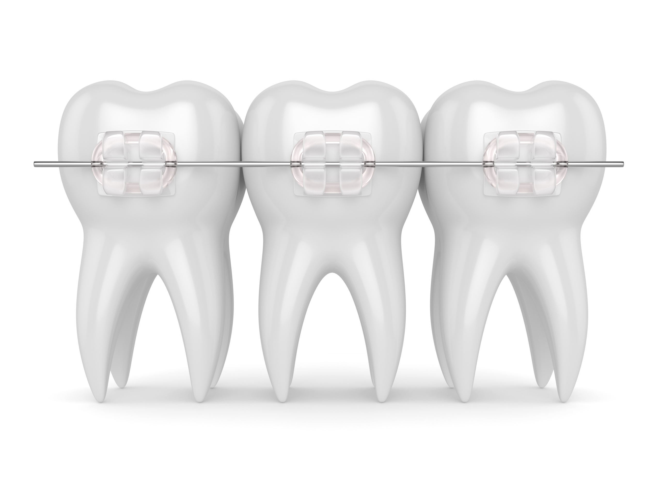 3d,Render,Of,Teeth,With,Ceramic,Clear,Braces,Isolated,Over